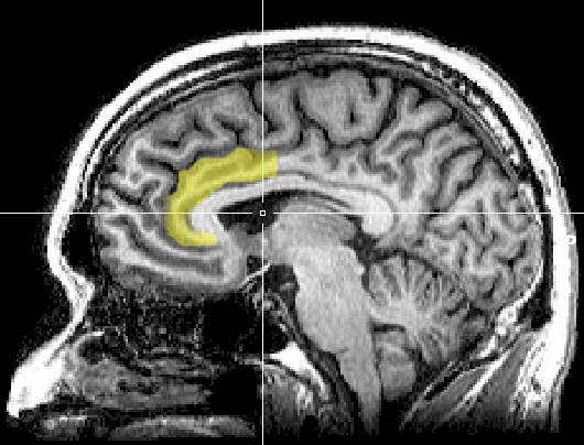 mri_anterior_cingulate1-7874715